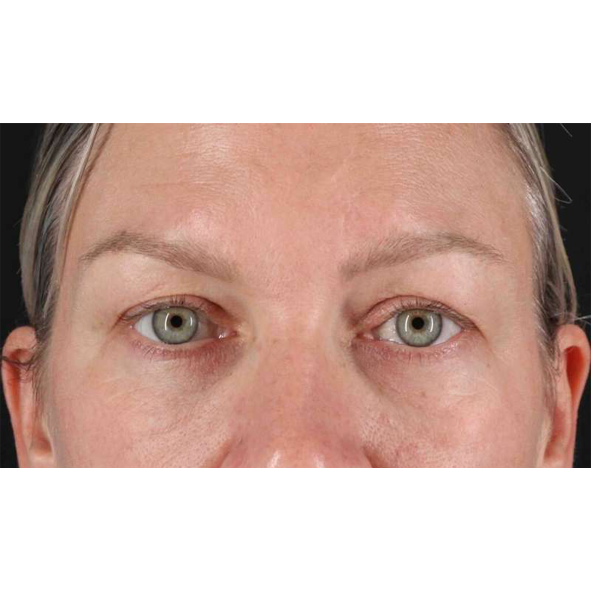 Blepharoplasty (Eyelid Surgery) Before & After Patient #10661