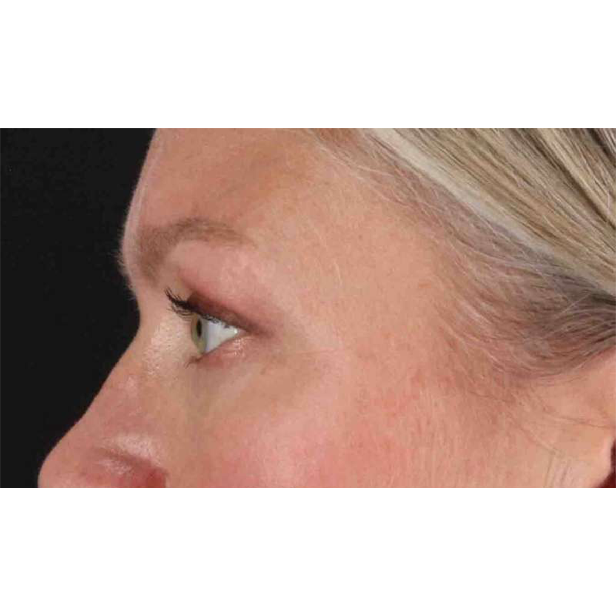 Blepharoplasty (Eyelid Surgery) Before & After Patient #10661
