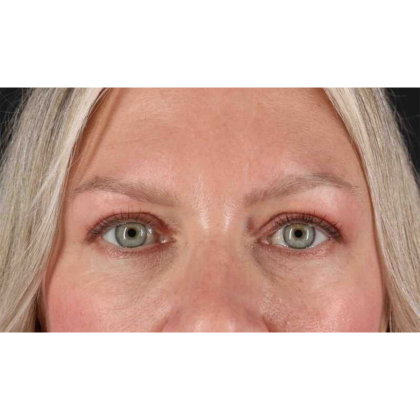 Blepharoplasty (Eyelid Surgery) Before & After Patient #10661