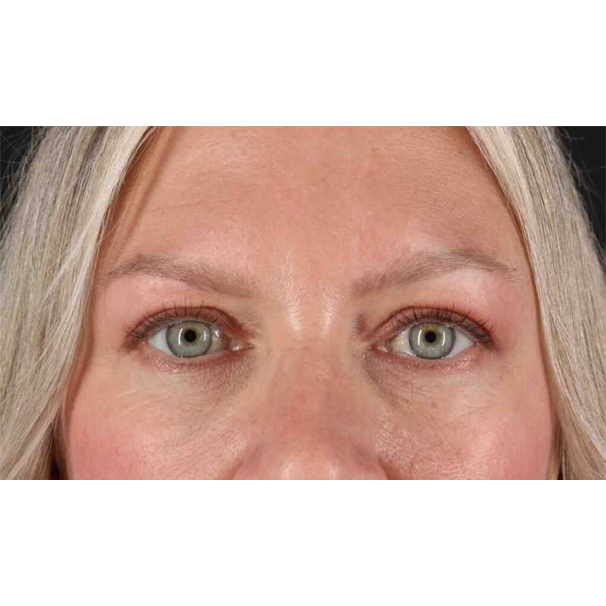 Blepharoplasty (Eyelid Surgery) Before & After Patient #10661