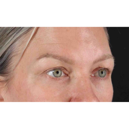 Blepharoplasty (Eyelid Surgery) Before & After Patient #10661