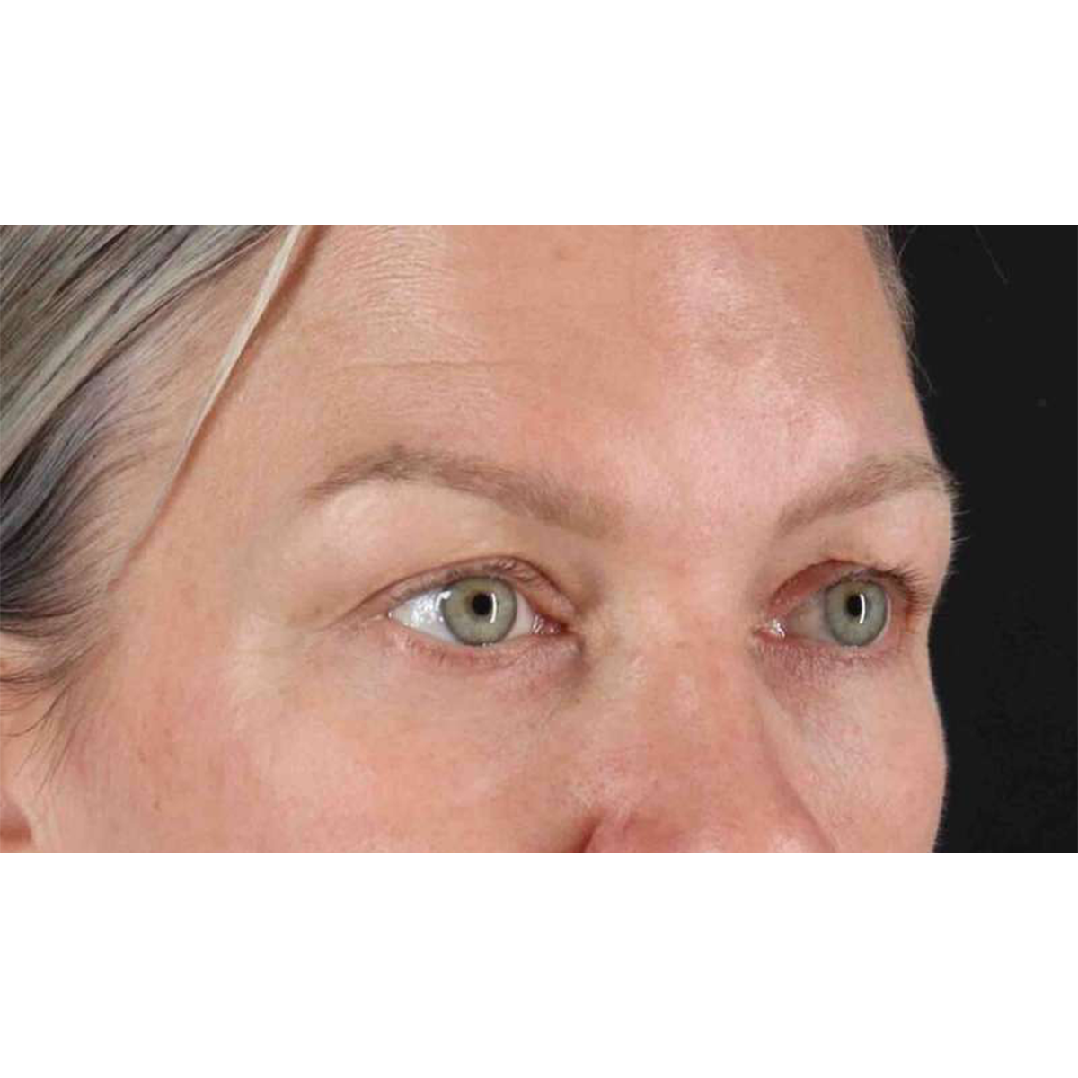 Blepharoplasty (Eyelid Surgery) Before & After Patient #10661