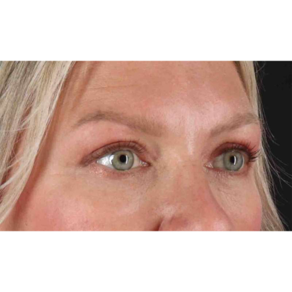 Blepharoplasty (Eyelid Surgery) Before & After Patient #10661
