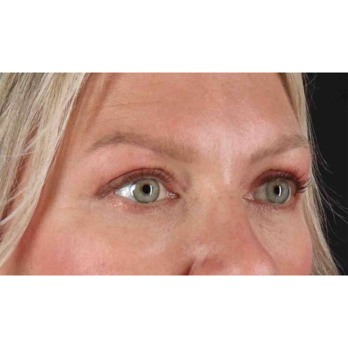 Blepharoplasty (Eyelid Surgery) Before & After Patient #10661