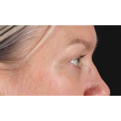 Blepharoplasty (Eyelid Surgery) Before & After Patient #10661