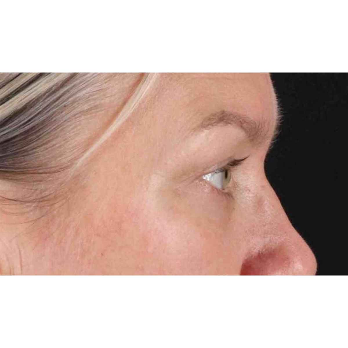 Blepharoplasty (Eyelid Surgery) Before & After Patient #10661