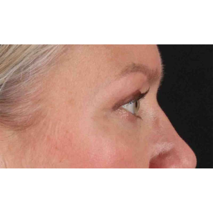 Blepharoplasty (Eyelid Surgery) Before & After Patient #10661