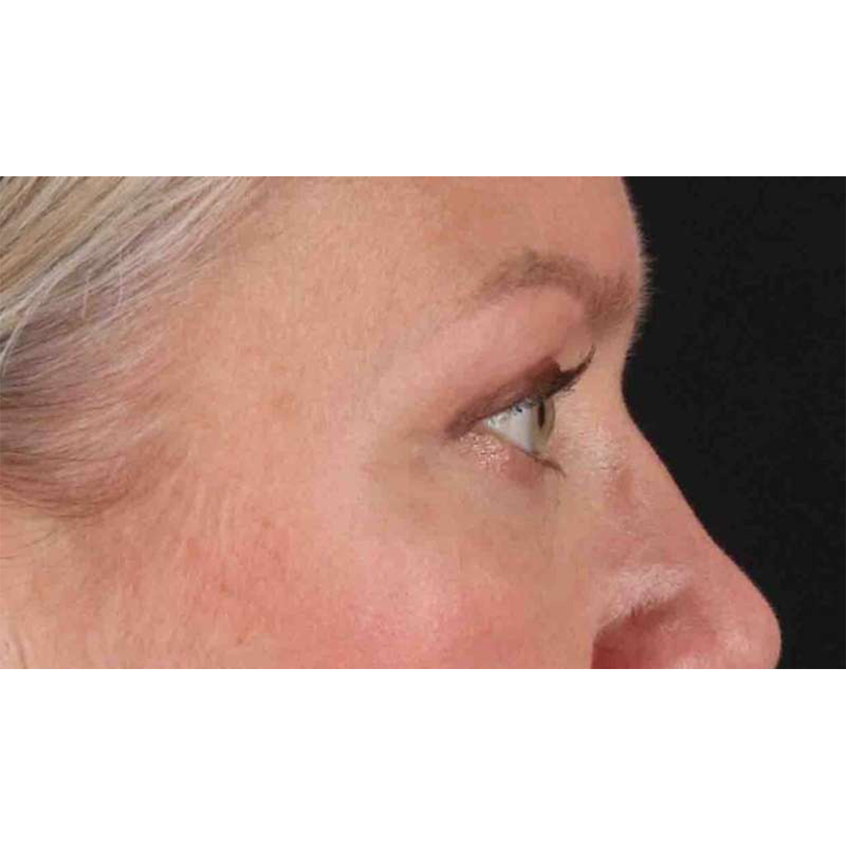 Blepharoplasty (Eyelid Surgery) Before & After Patient #10661