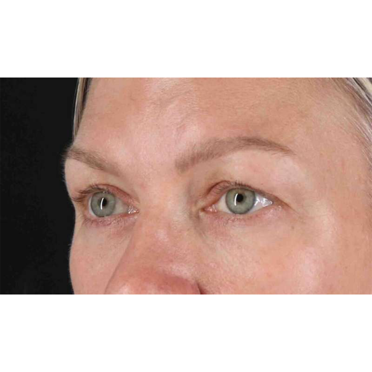 Blepharoplasty (Eyelid Surgery) Before & After Patient #10661