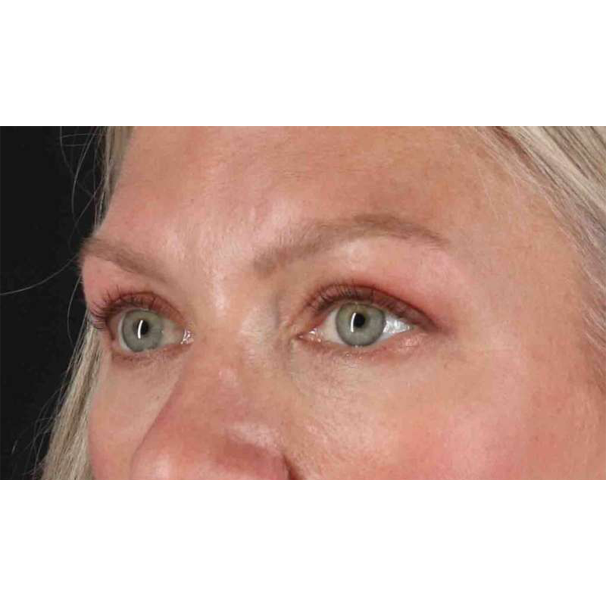 Blepharoplasty (Eyelid Surgery) Before & After Patient #10661