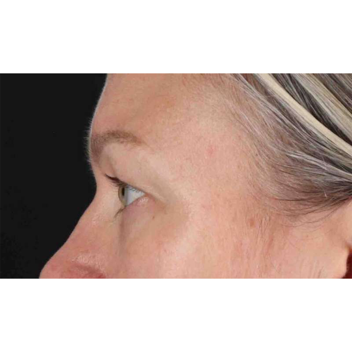 Blepharoplasty (Eyelid Surgery) Before & After Patient #10661