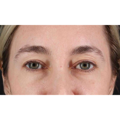 Blepharoplasty (Eyelid Surgery) Before & After Patient #10650