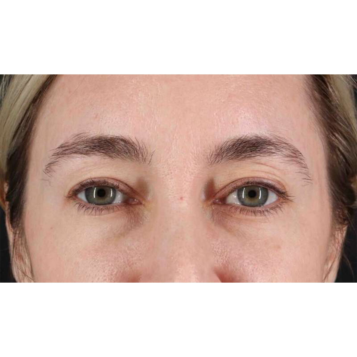 Blepharoplasty (Eyelid Surgery) Before & After Patient #10650