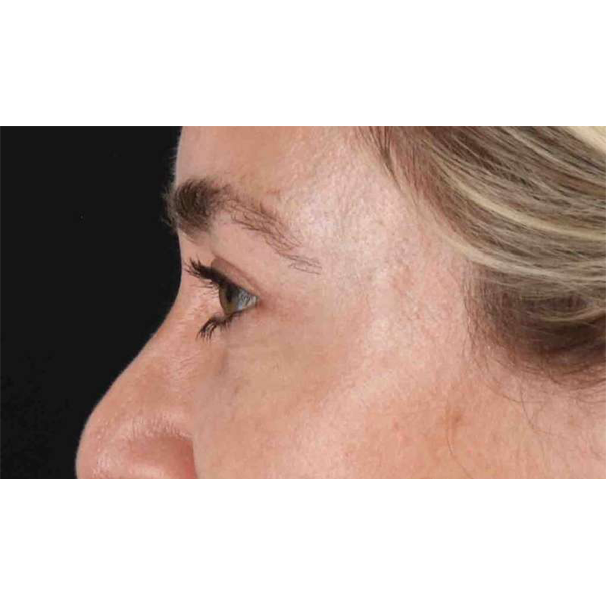 Blepharoplasty (Eyelid Surgery) Before & After Patient #10650