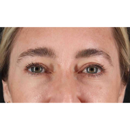 Blepharoplasty (Eyelid Surgery) Before & After Patient #10650