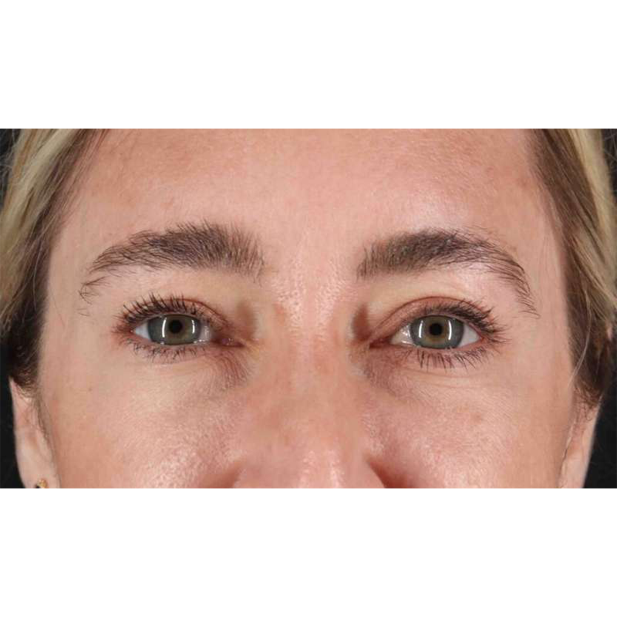 Blepharoplasty (Eyelid Surgery) Before & After Patient #10650