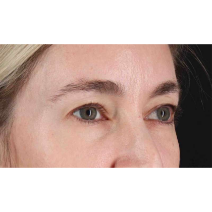 Blepharoplasty (Eyelid Surgery) Before & After Patient #10650