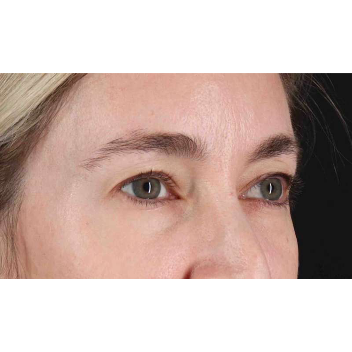 Blepharoplasty (Eyelid Surgery) Before & After Patient #10650