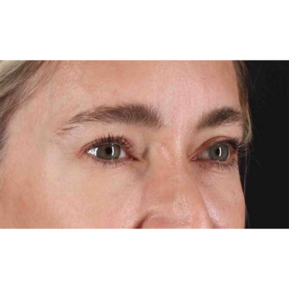 Blepharoplasty (Eyelid Surgery) Before & After Patient #10650