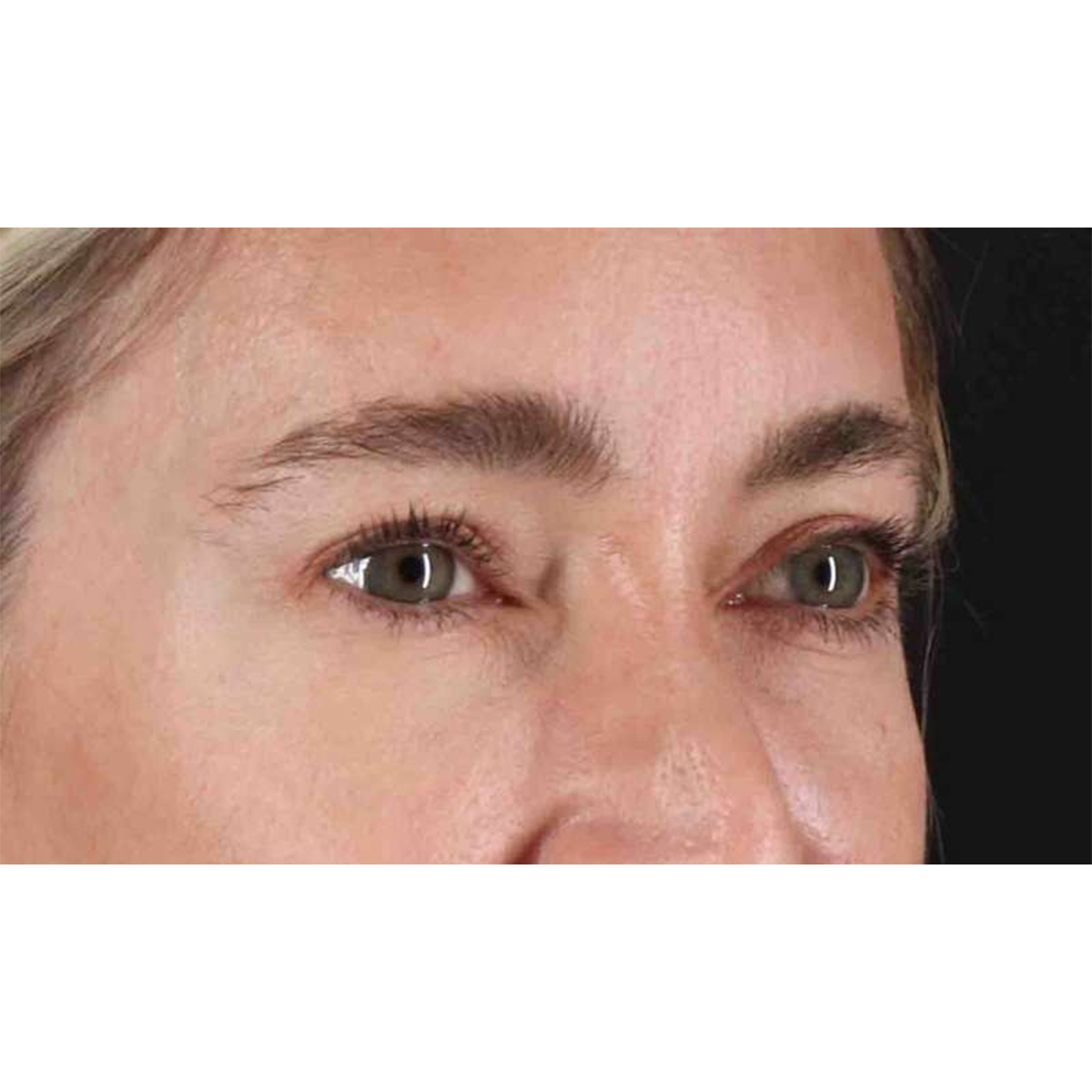Blepharoplasty (Eyelid Surgery) Before & After Patient #10650