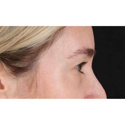 Blepharoplasty (Eyelid Surgery) Before & After Patient #10650