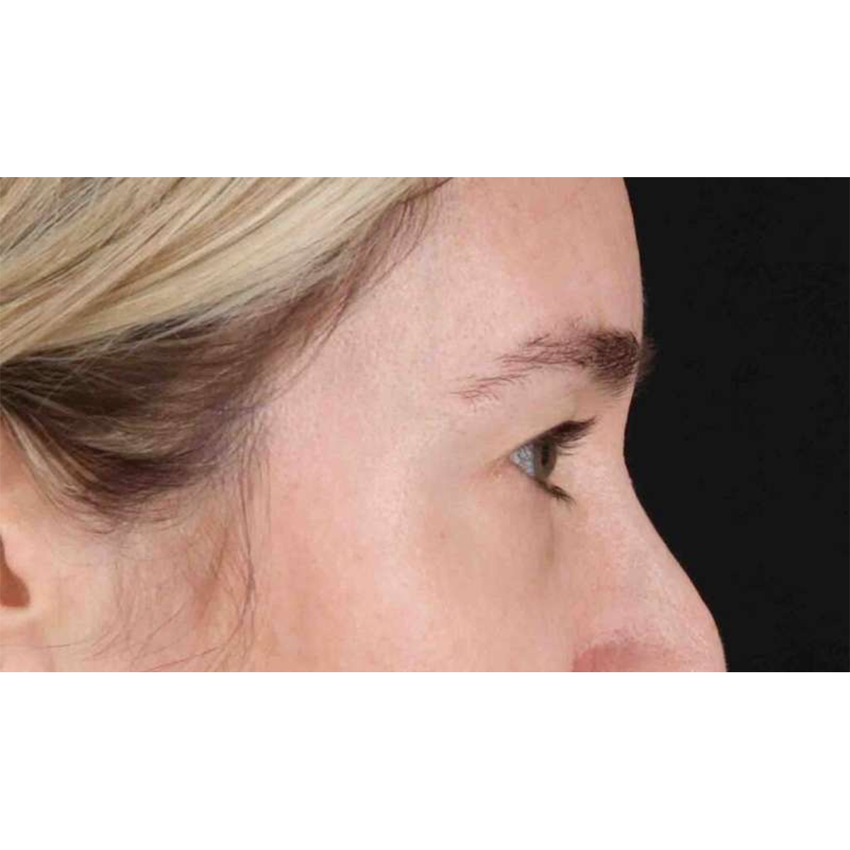 Blepharoplasty (Eyelid Surgery) Before & After Patient #10650