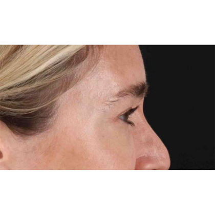Blepharoplasty (Eyelid Surgery) Before & After Patient #10650