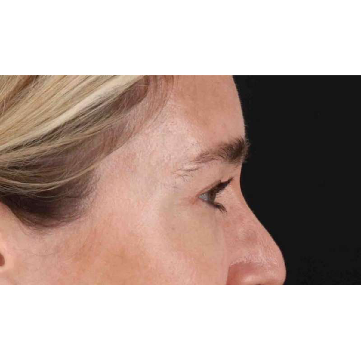 Blepharoplasty (Eyelid Surgery) Before & After Patient #10650