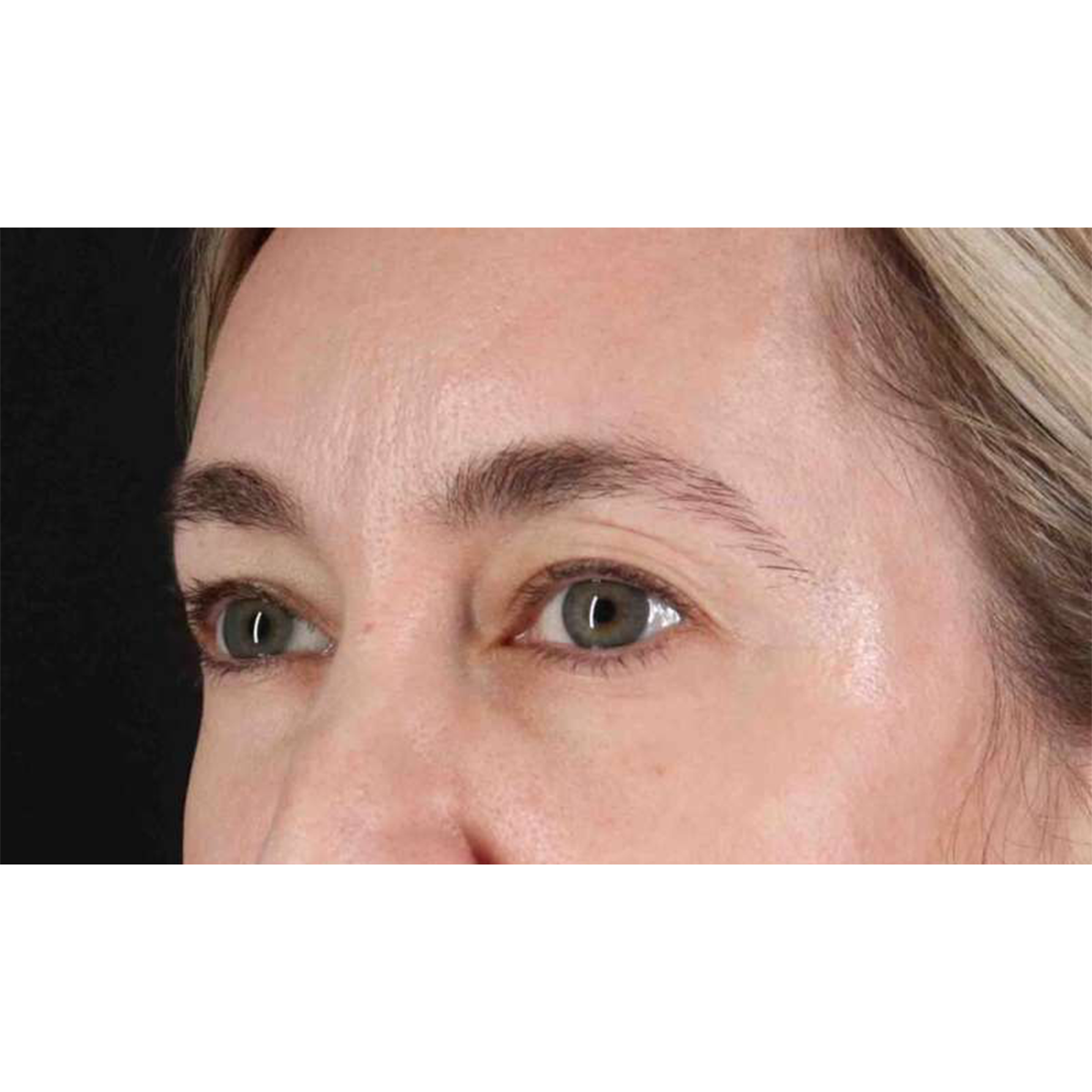 Blepharoplasty (Eyelid Surgery) Before & After Patient #10650