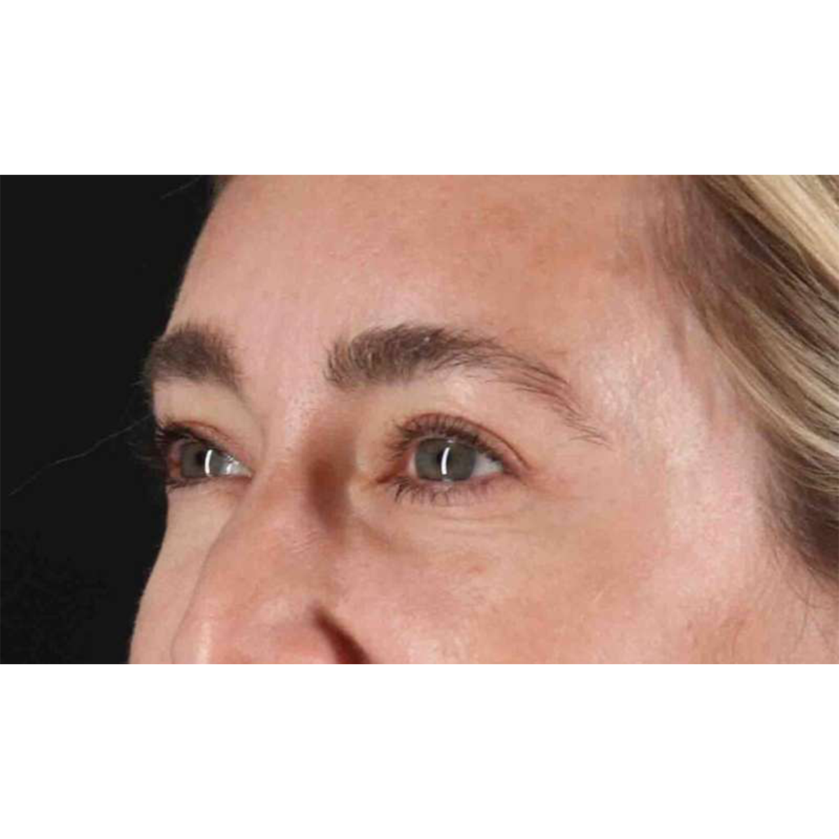 Blepharoplasty (Eyelid Surgery) Before & After Patient #10650