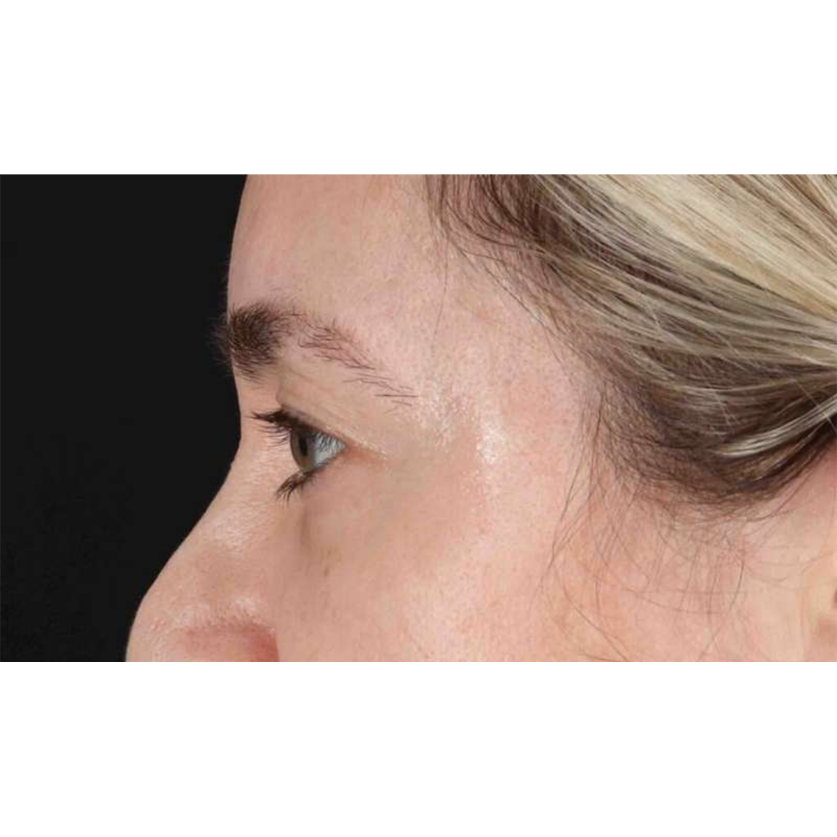 Blepharoplasty (Eyelid Surgery) Before & After Patient #10650