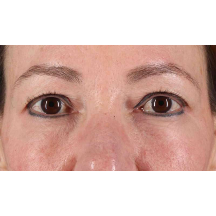Blepharoplasty (Eyelid Surgery) Before & After Patient #10639