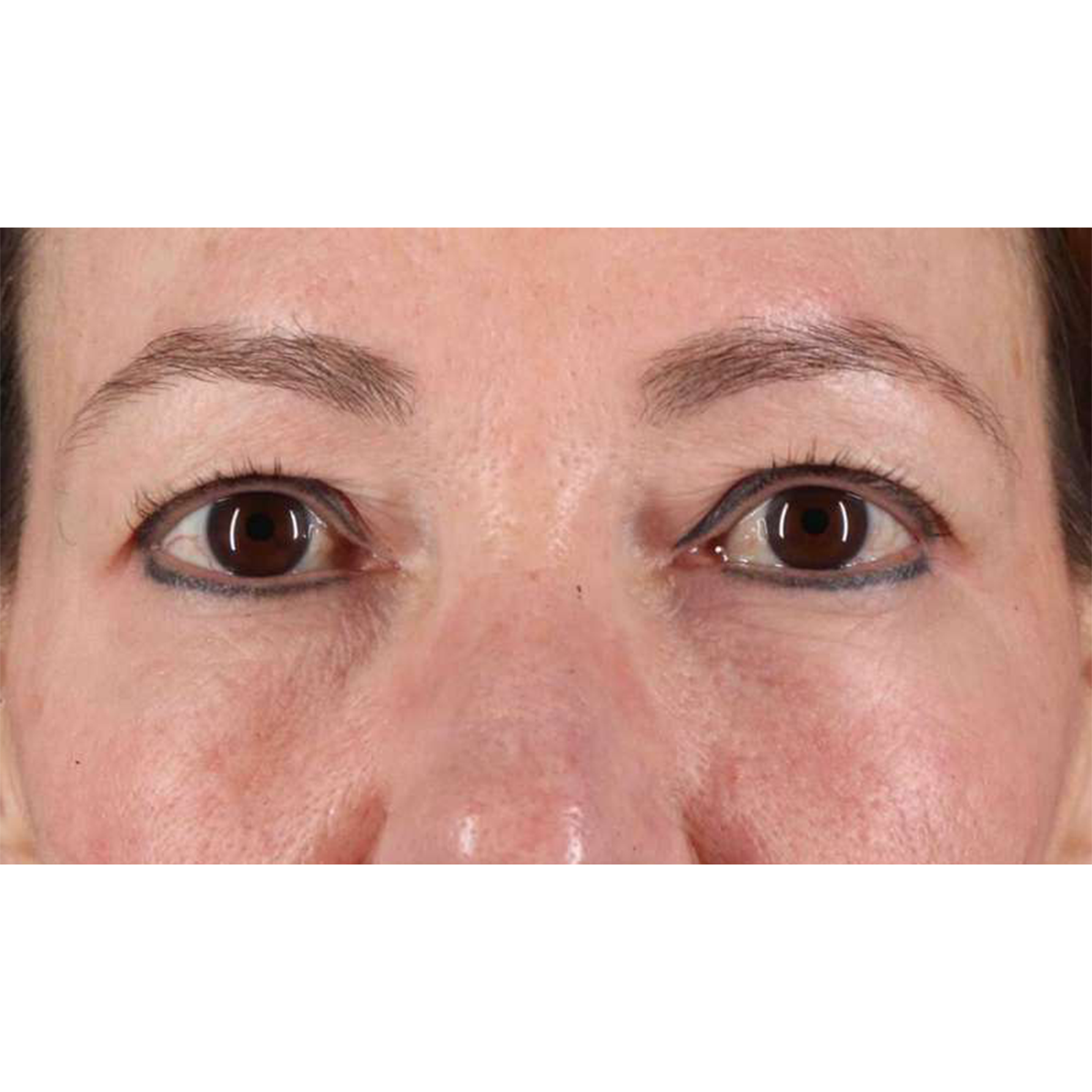 Blepharoplasty (Eyelid Surgery) Before & After Patient #10639