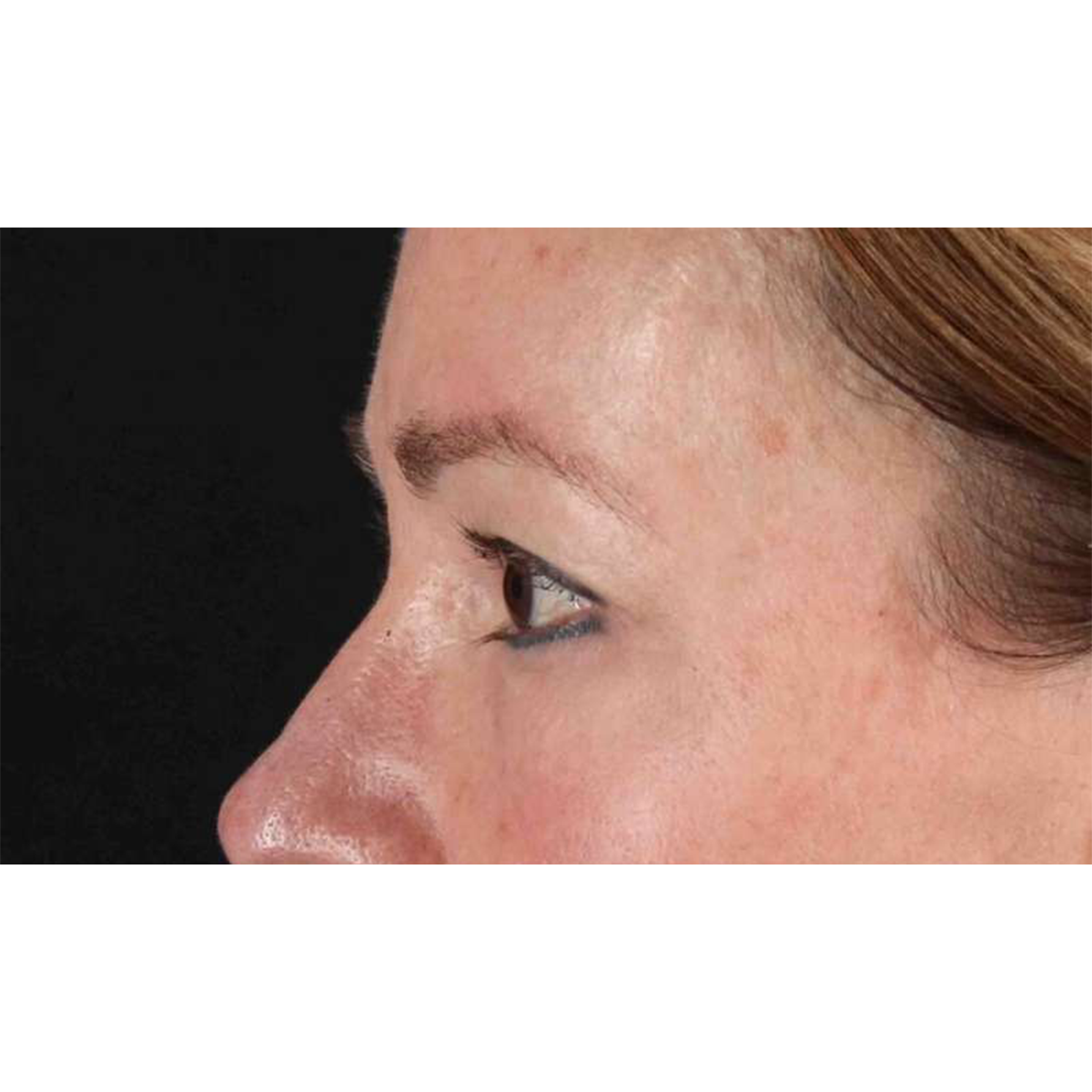 Blepharoplasty (Eyelid Surgery) Before & After Patient #10639