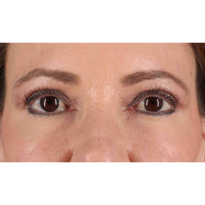 Blepharoplasty (Eyelid Surgery) Before & After Patient #10639