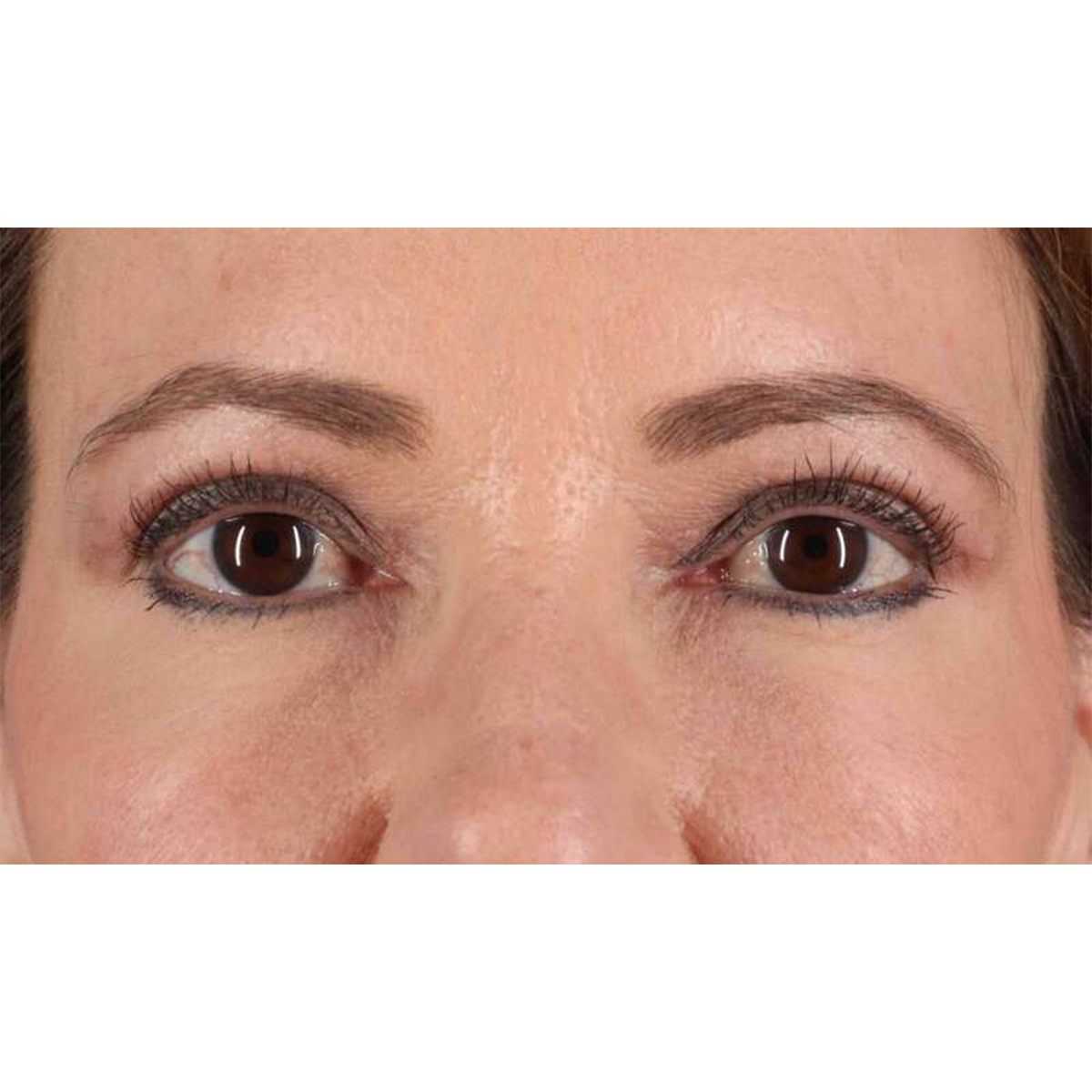 Blepharoplasty (Eyelid Surgery) Before & After Patient #10639