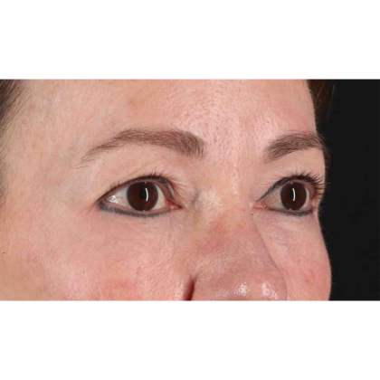 Blepharoplasty (Eyelid Surgery) Before & After Patient #10639