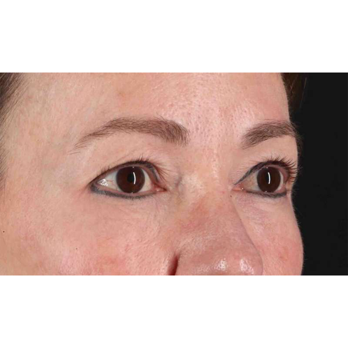 Blepharoplasty (Eyelid Surgery) Before & After Patient #10639