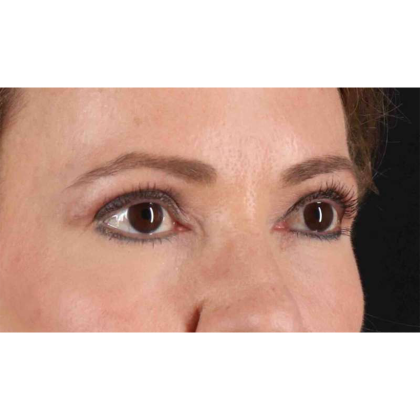 Blepharoplasty (Eyelid Surgery) Before & After Patient #10639