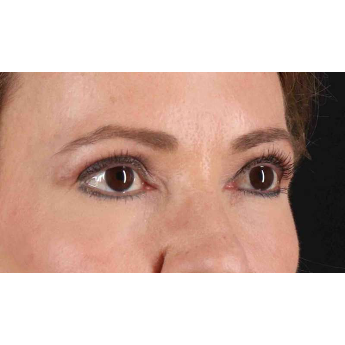 Blepharoplasty (Eyelid Surgery) Before & After Patient #10639