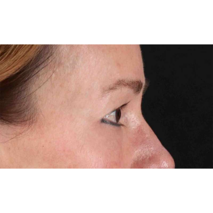 Blepharoplasty (Eyelid Surgery) Before & After Patient #10639