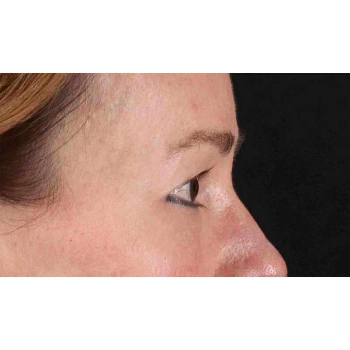 Blepharoplasty (Eyelid Surgery) Before & After Patient #10639