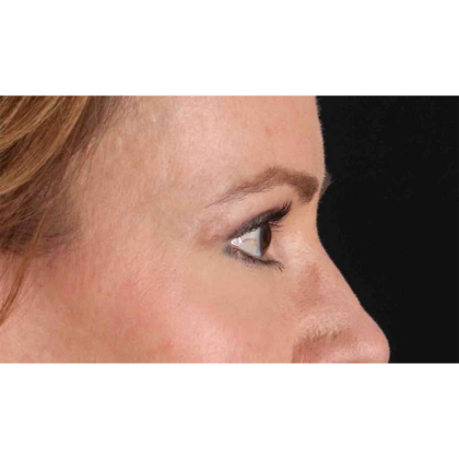 Blepharoplasty (Eyelid Surgery) Before & After Patient #10639