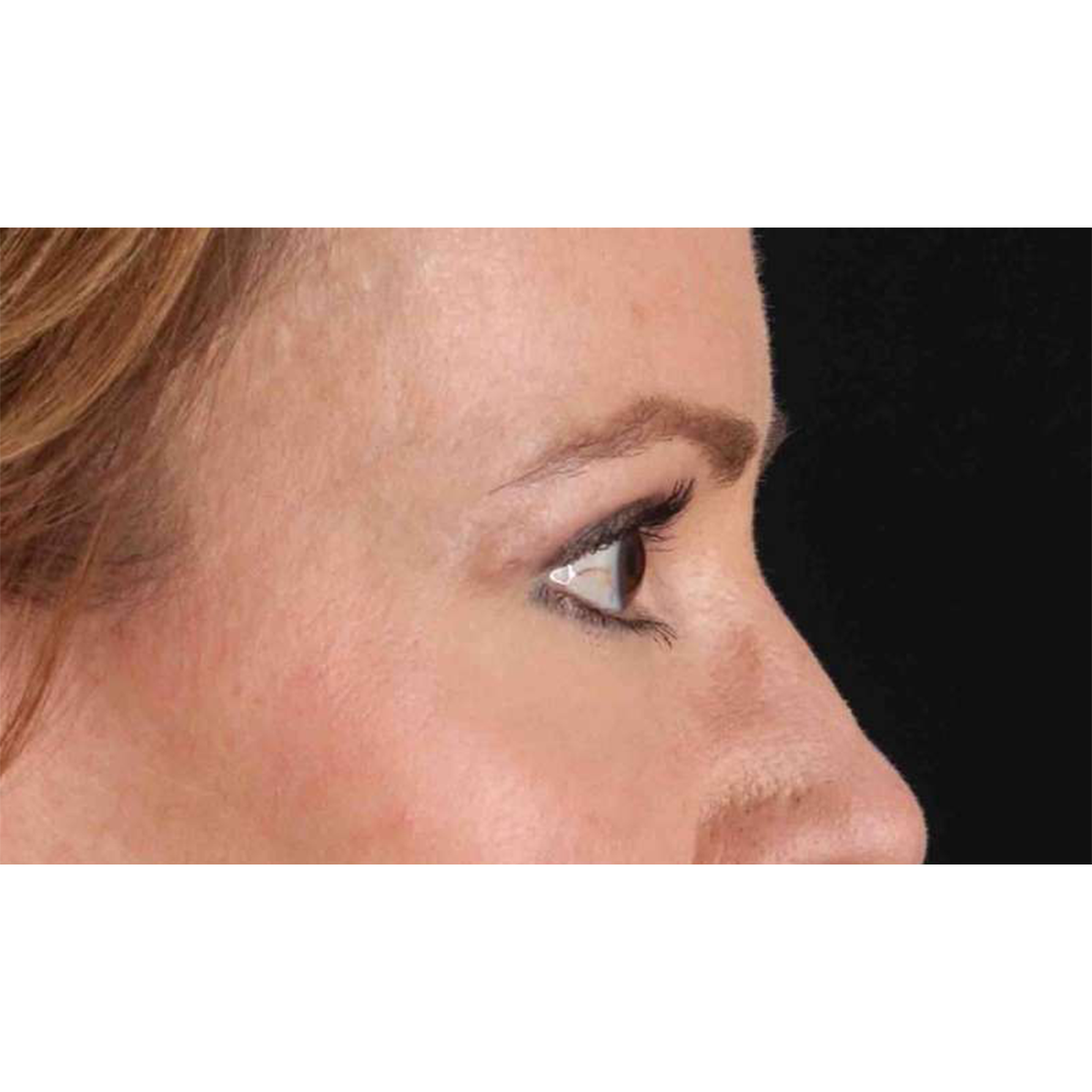 Blepharoplasty (Eyelid Surgery) Before & After Patient #10639