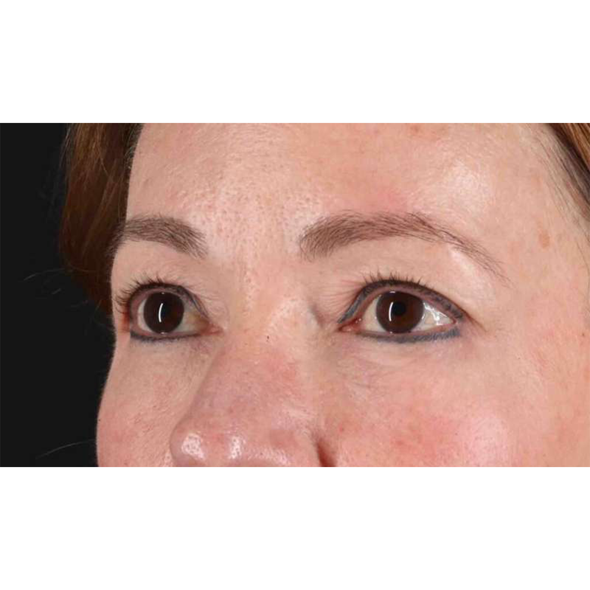 Blepharoplasty (Eyelid Surgery) Before & After Patient #10639