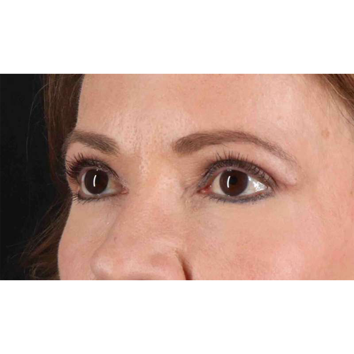 Blepharoplasty (Eyelid Surgery) Before & After Patient #10639