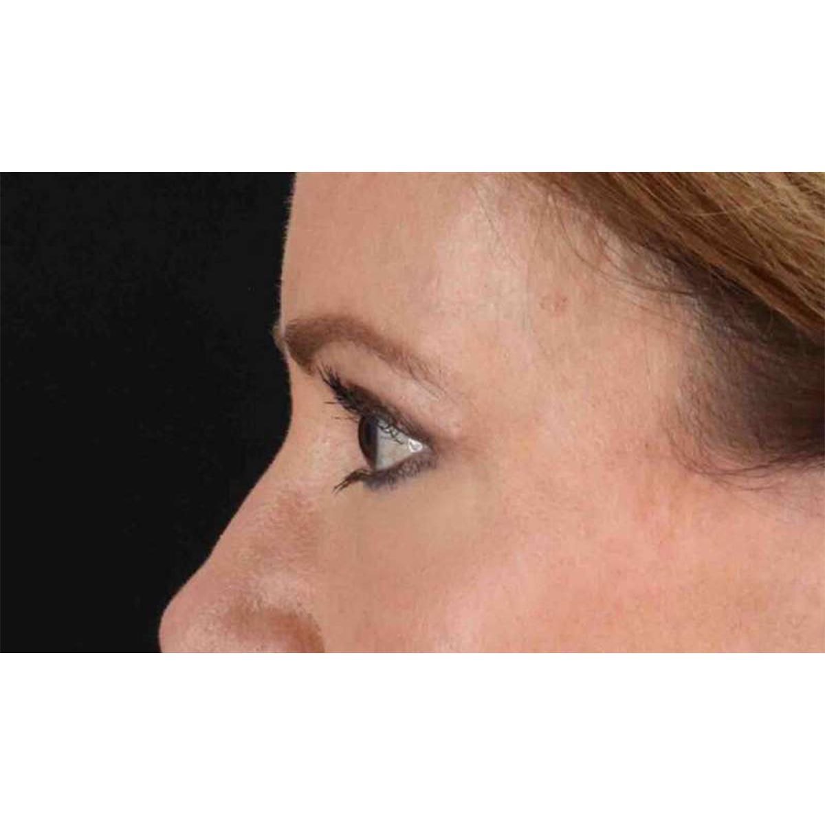 Blepharoplasty (Eyelid Surgery) Before & After Patient #10639