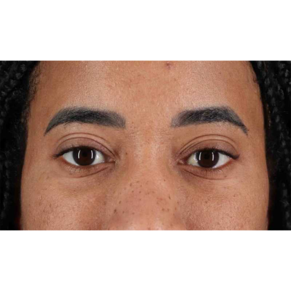 Blepharoplasty (Eyelid Surgery) Before & After Patient #10793