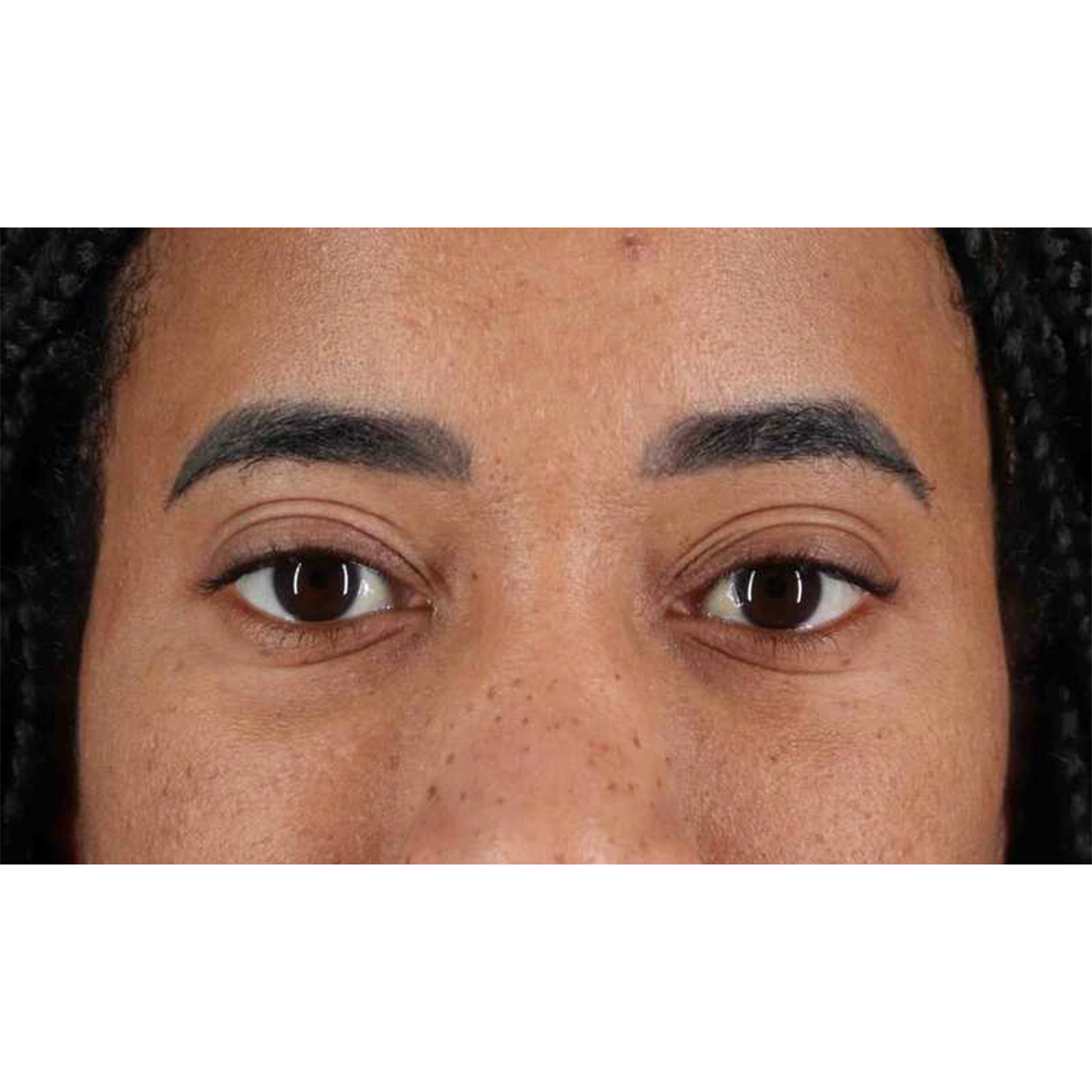 Blepharoplasty (Eyelid Surgery) Before & After Patient #10793