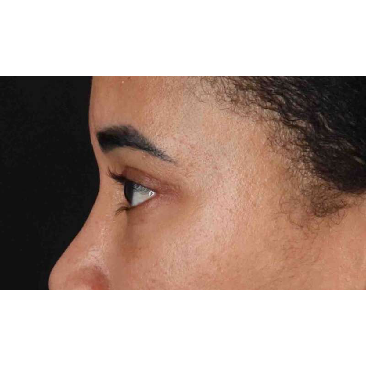Blepharoplasty (Eyelid Surgery) Before & After Patient #10793